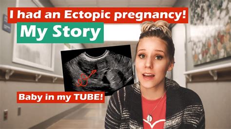 Its a story about the scariest and most heartbreaking thing thats ever happened to me in my life my ectopic pregnancy. . Ectopic pregnancy stories mumsnet
